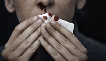 Woman with nosebleed