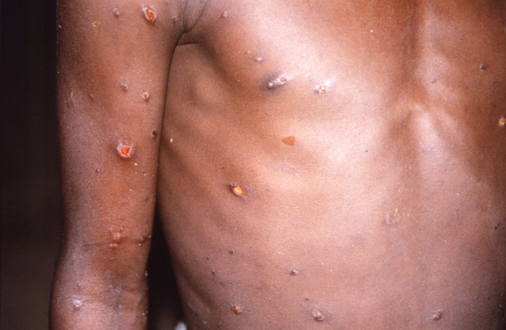 Monkeypox Lesions