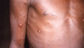 Monkeypox Lesions