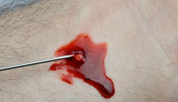 Drawing blood from a human arm